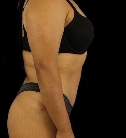 Abdominoplasty (Tummy Tuck) Before & After Patient #601