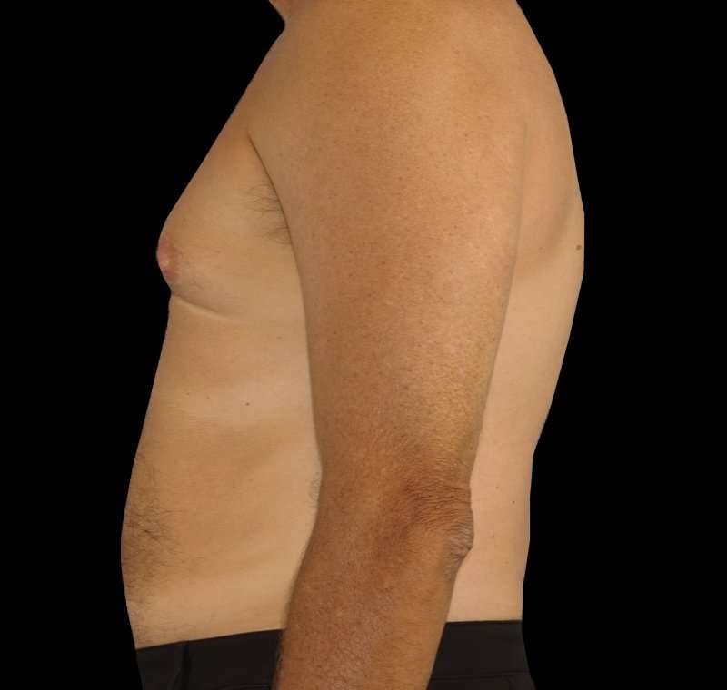 Liposuction Before & After Patient #1270
