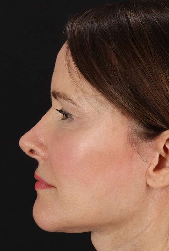 Neck Lift Before & After Patient #6631