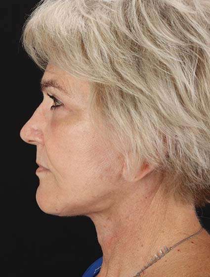 Neck Lift Before & After Patient #6654