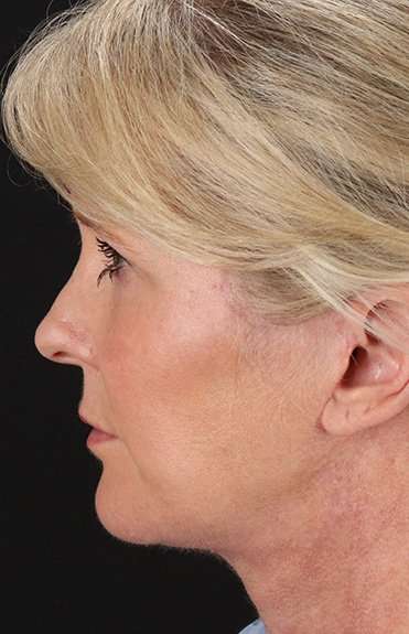 Neck Lift Before & After Patient #6720