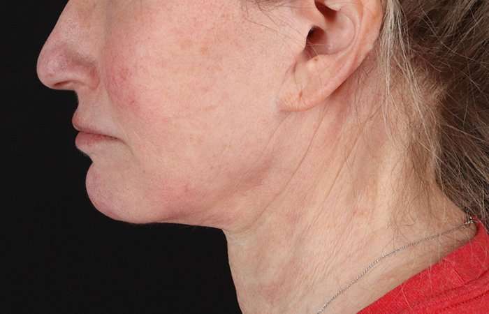Neck Lift Before & After Patient #6731