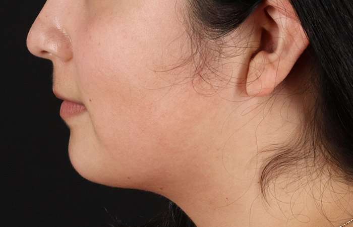 Neck Lift Before & After Patient #6743