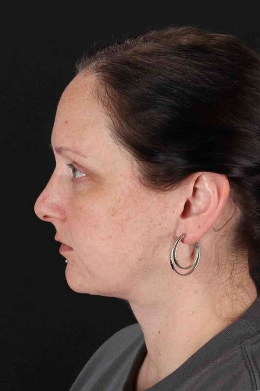 Neck Lift Before & After Patient #6756