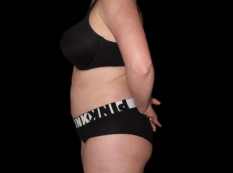 Liposuction Before & After Patient #1298