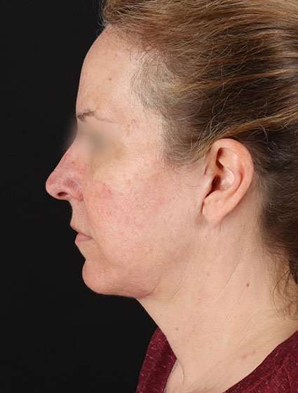 Neck Lift Before & After Patient #6838