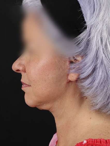 Neck Lift Before & After Patient #6878