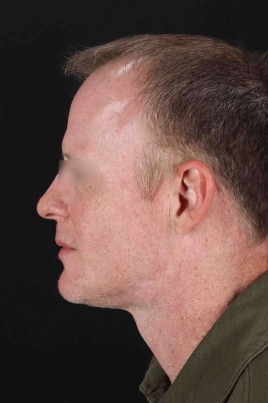 CO2 Laser Before & After Patient #6931