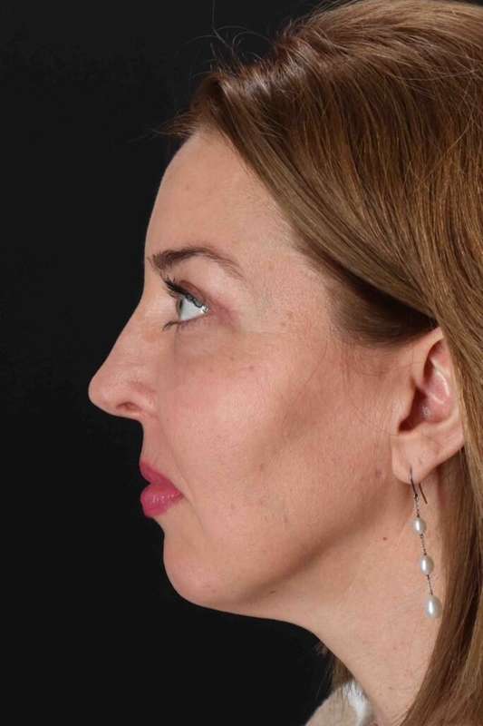 CO2 Laser Before & After Patient #6953