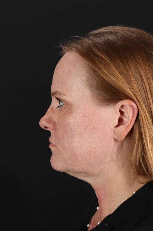 CO2 Laser Before & After Patient #6997