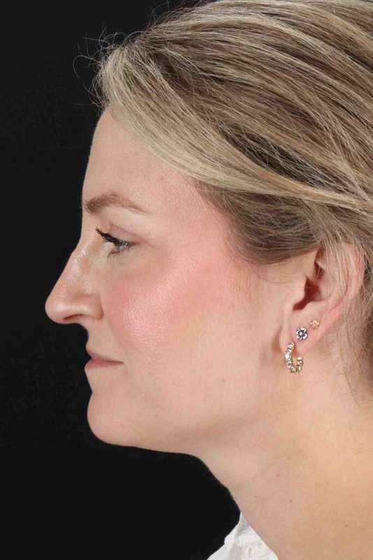 CO2 Laser Before & After Patient #7019