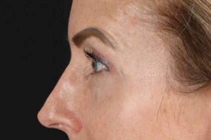CO2 Laser Before & After Patient #7030