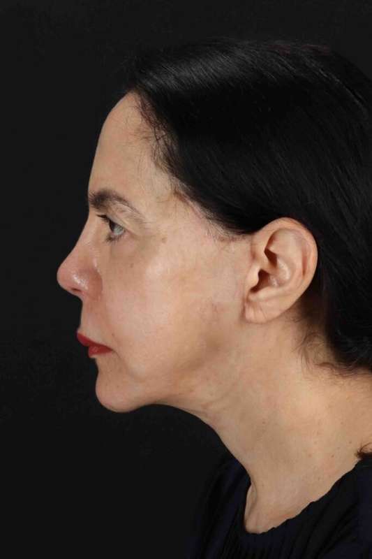 CO2 Laser Before & After Patient #7041