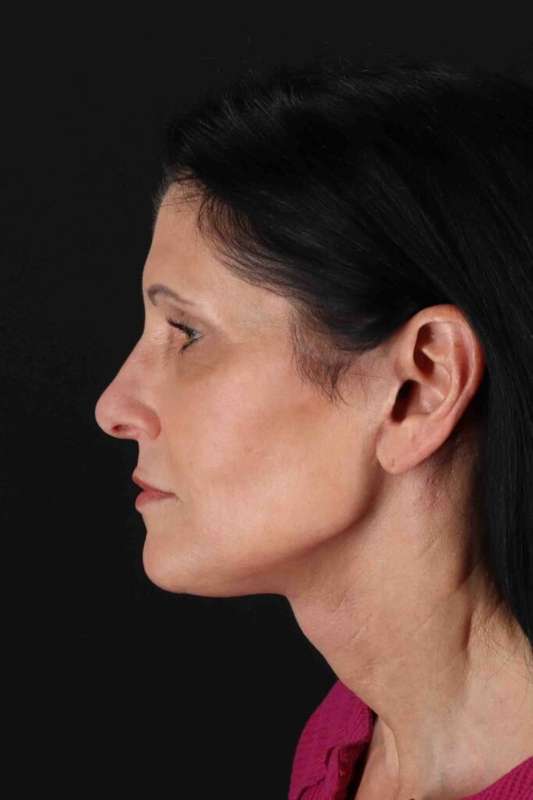 CO2 Laser Before & After Patient #7063