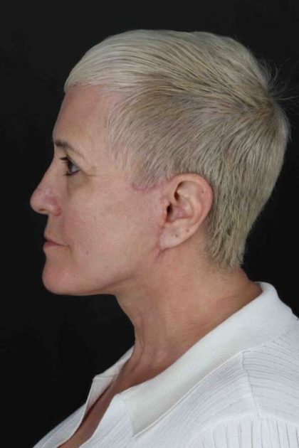 CO2 Laser Before & After Patient #7117