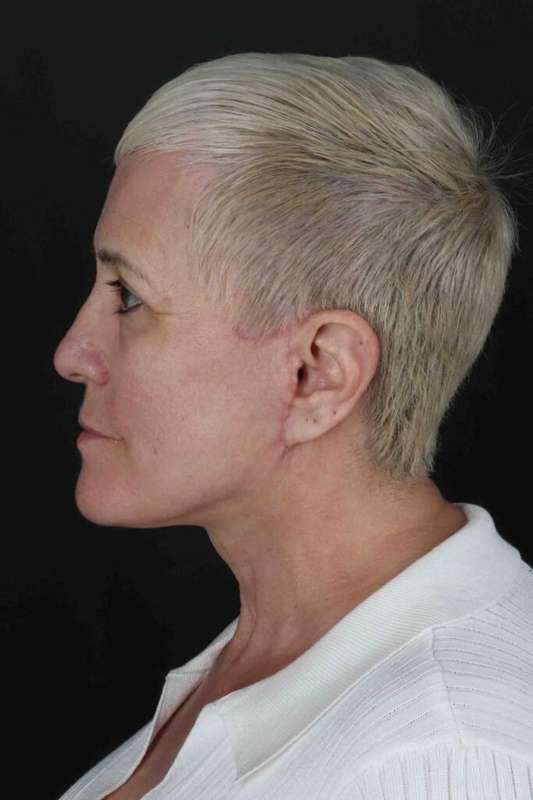 CO2 Laser Before & After Patient #7117