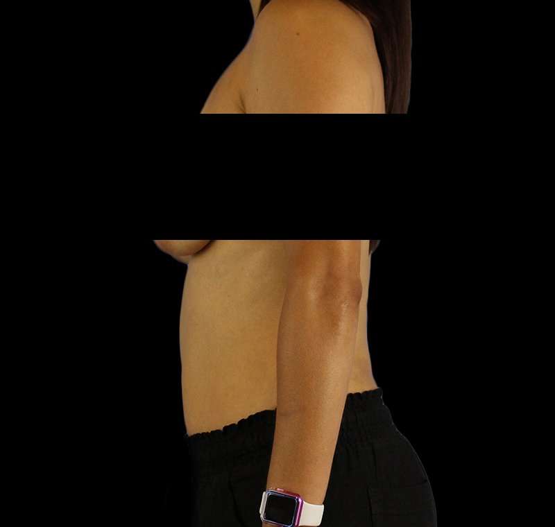 Liposuction Before & After Patient #1332