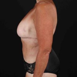 Liposuction Before & After Patient #1348