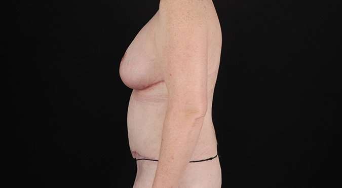 Liposuction Before & After Patient #1387