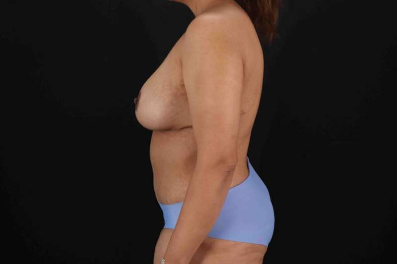 Liposuction Before & After Patient #1403
