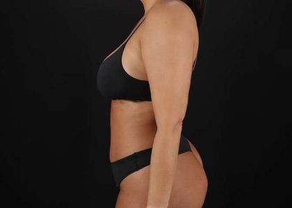 Liposuction Before & After Patient #1469