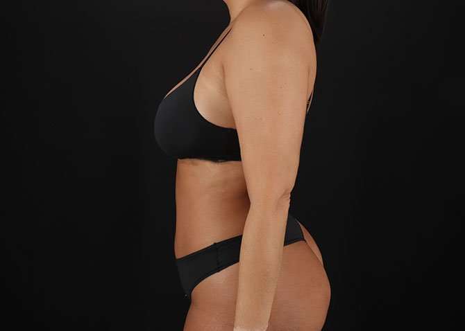Liposuction Before & After Patient #1469
