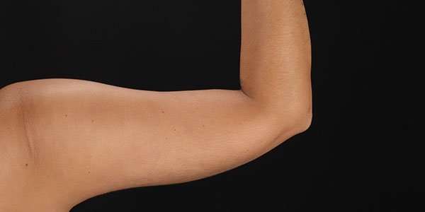 Liposuction Before & After Patient #1482