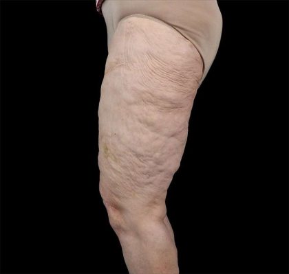 Liposuction Before & After Patient #1495