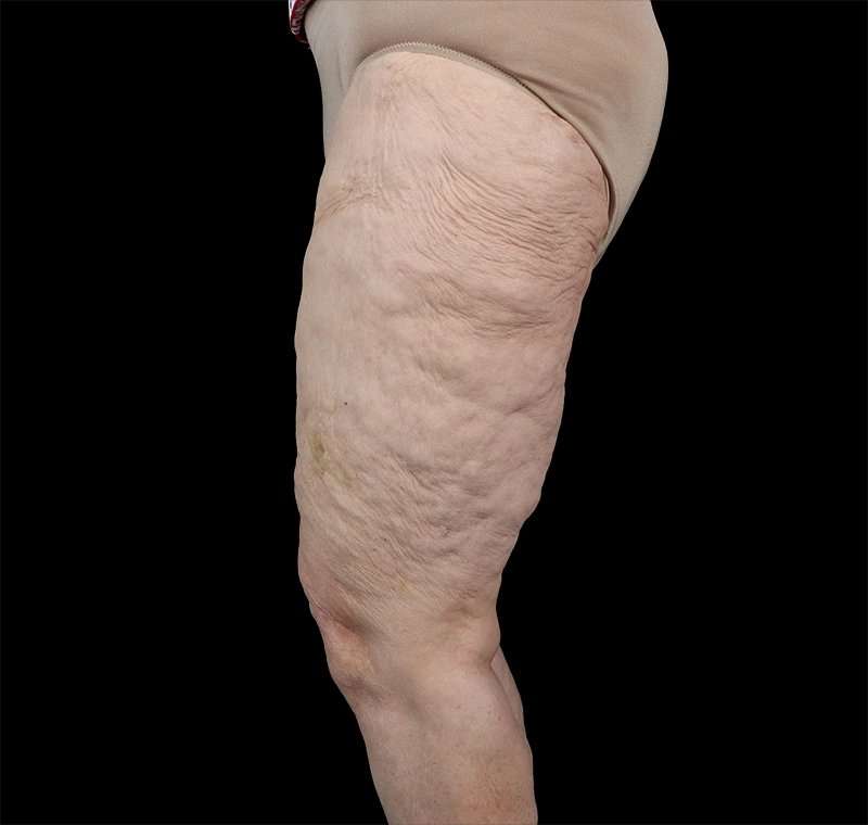 Liposuction Before & After Patient #1495