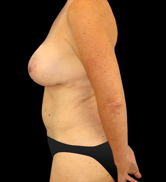 Mommy Makeover Before & After Patient #1535
