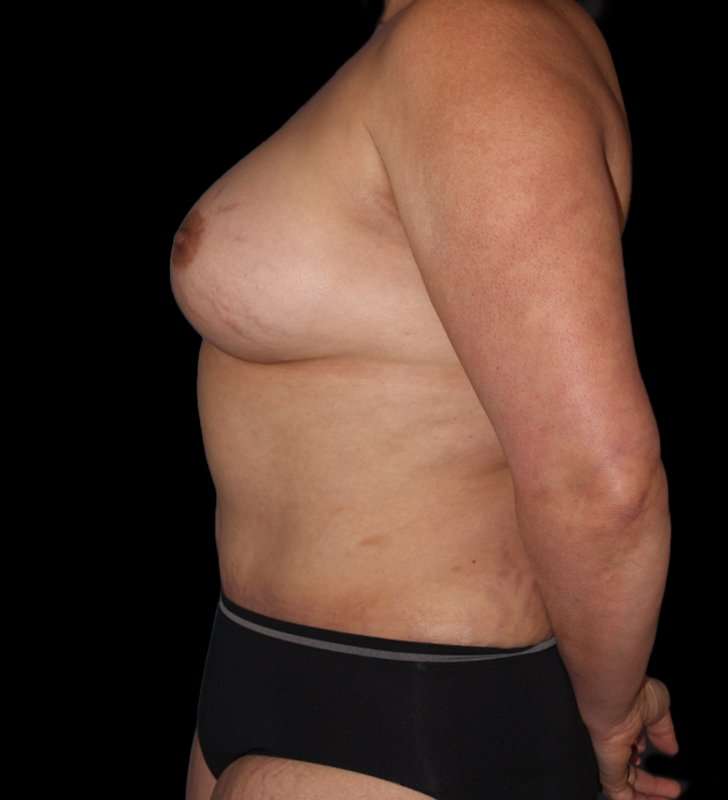 Mommy Makeover Before & After Patient #1547