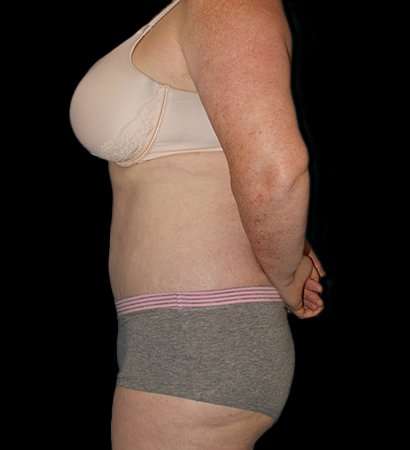 Abdominoplasty (Tummy Tuck) Before & After Patient #625
