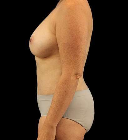 Mommy Makeover Before & After Patient #1738