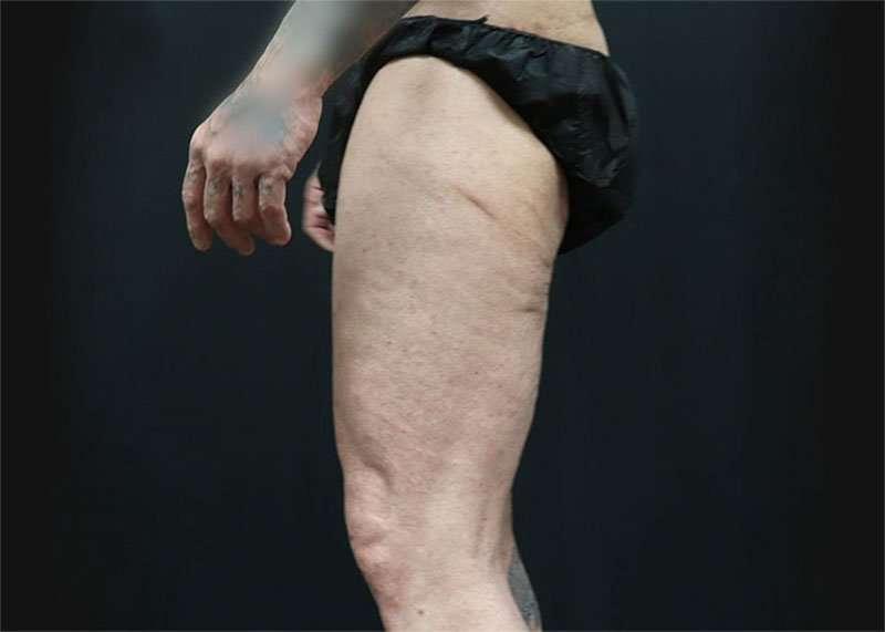 Thigh Lift Before & After Patient #1776