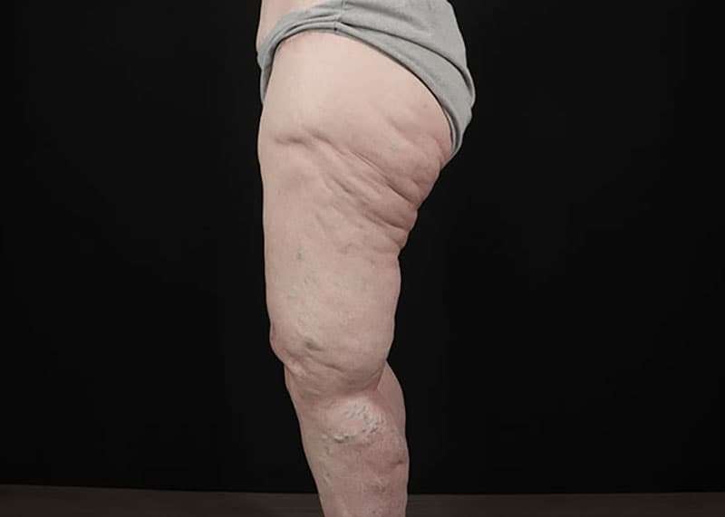 Thigh Lift Before & After Patient #1790