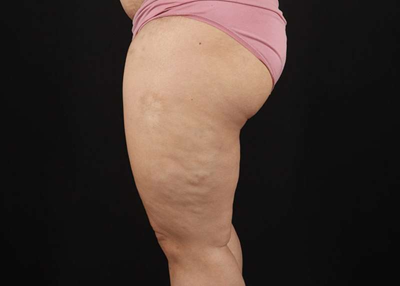 Thigh Lift Before & After Patient #1804