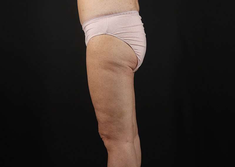 Thigh Lift Before & After Patient #1818