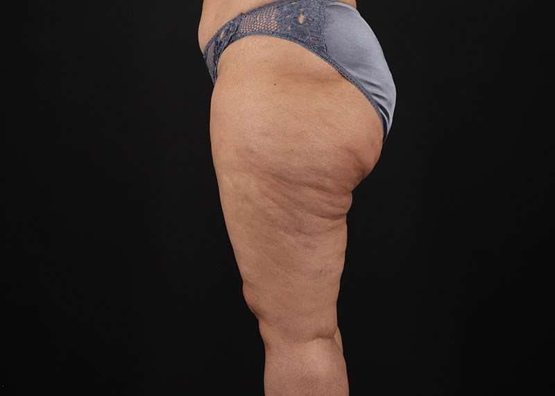 Thigh Lift Before & After Patient #1831