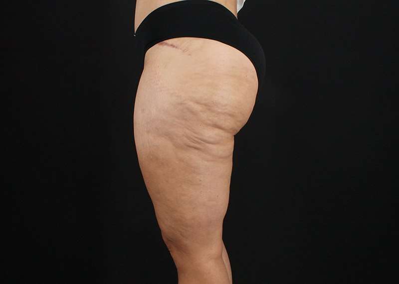 Thigh Lift Before & After Patient #1844