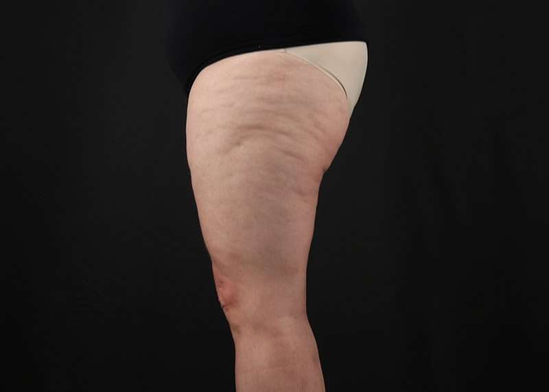 Thigh Lift Before & After Patient #1857