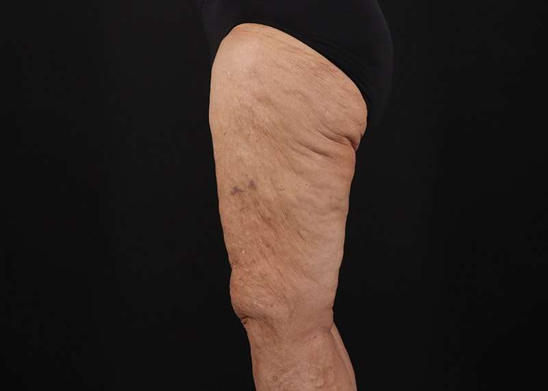 Thigh Lift Before & After Patient #1871