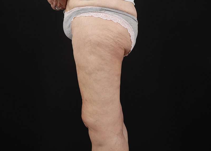 Thigh Lift Before & After Patient #1884