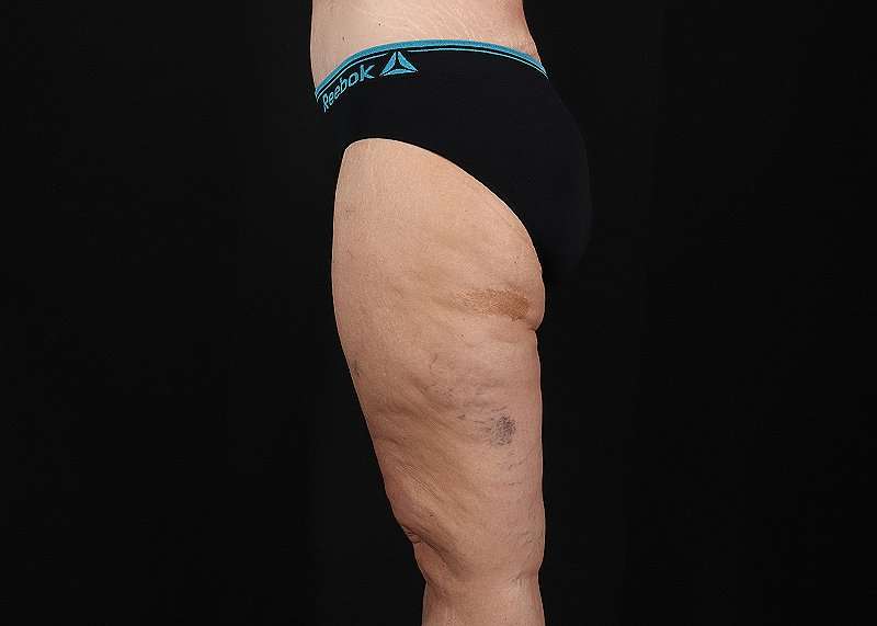 Thigh Lift Before & After Patient #1897