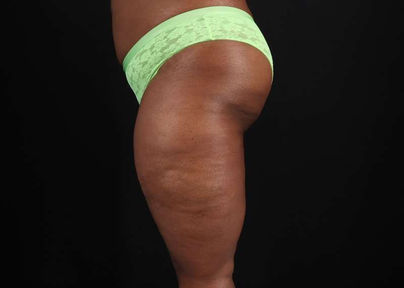 Thigh Lift Before & After Patient #1911
