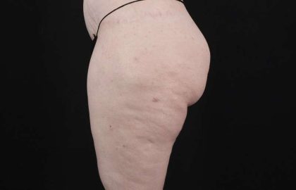 Thigh Lift Before & After Patient #1925