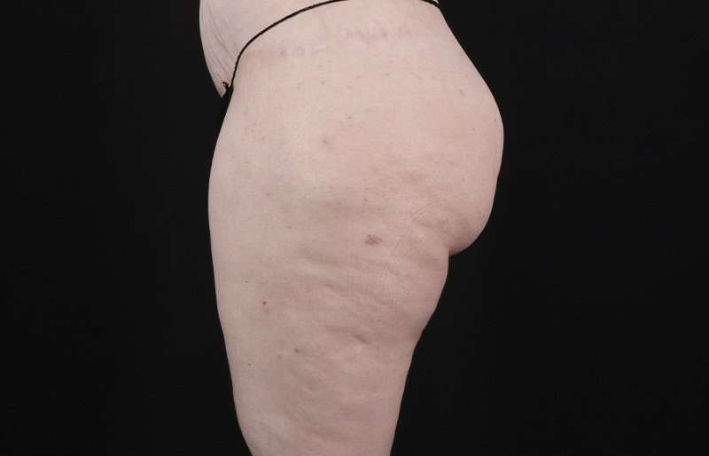 Thigh Lift Before & After Patient #1925