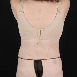 Back Lift/Tuck Before & After Patient #1939