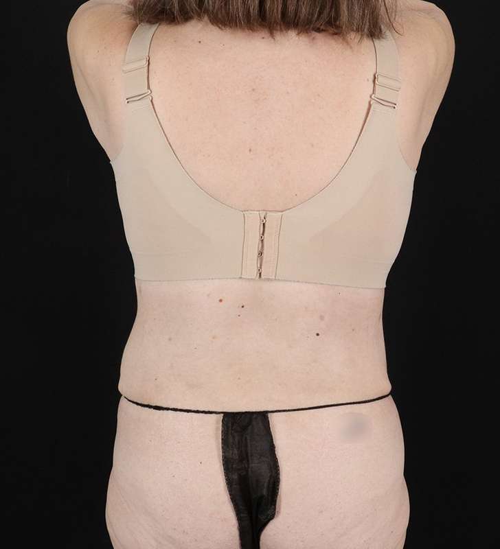 Back Lift/Tuck Before & After Patient #1939