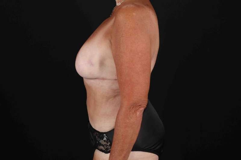 Abdominoplasty (Tummy Tuck) Before & After Patient #664