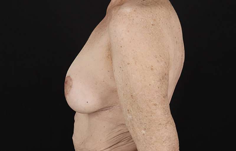 Breast Augmentation w/ Fat Transfer Before & After Patient #2049
